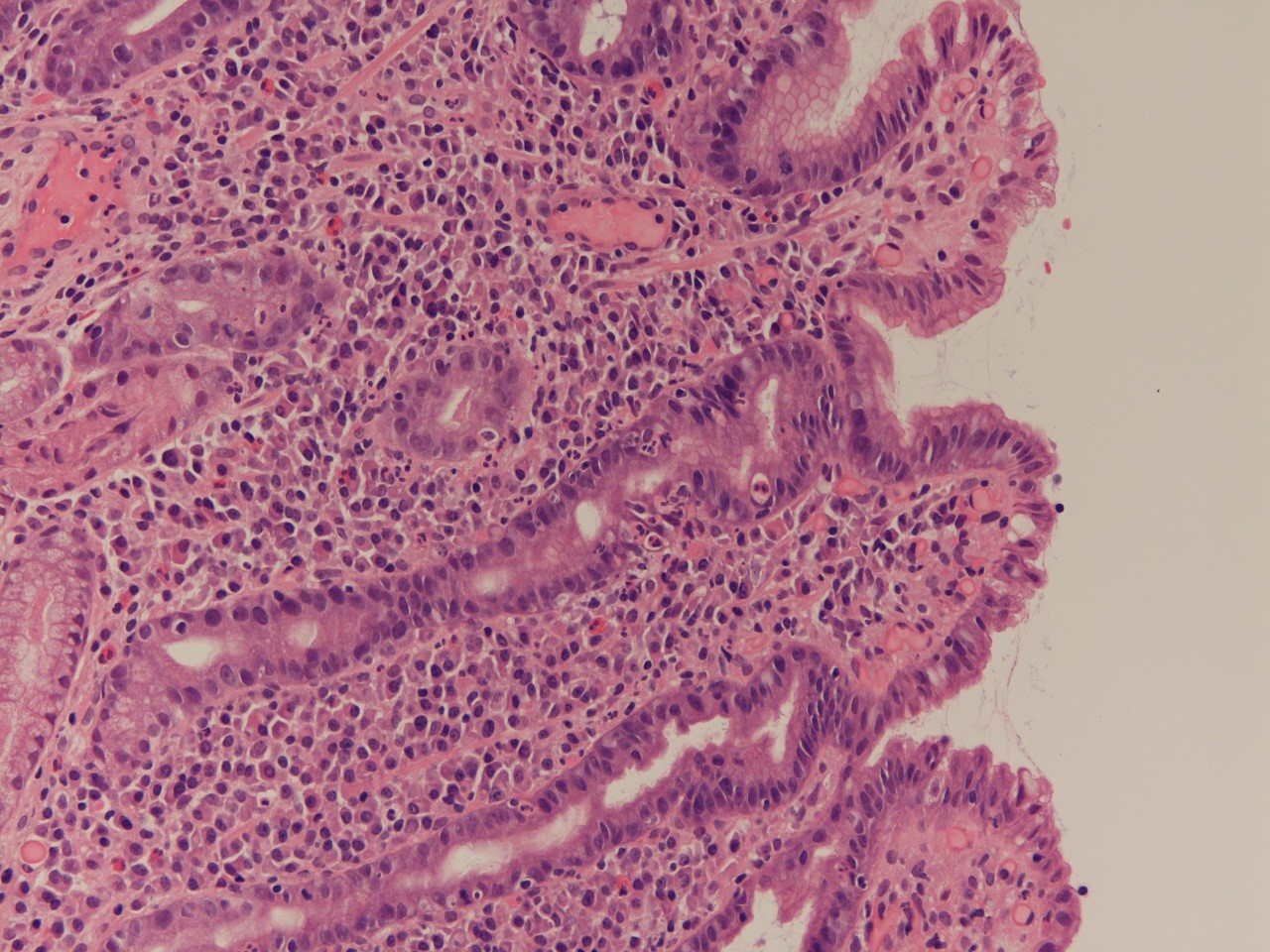 Helicobacter pylori gastritis